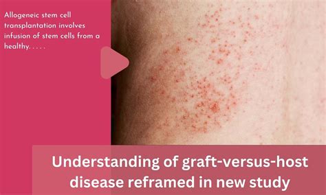 Understanding Of Graft Versus Host Disease Reframed In New Study