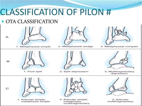 Pilon Fractures