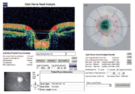 Optic Nerve Head Analysis With Oct Open I