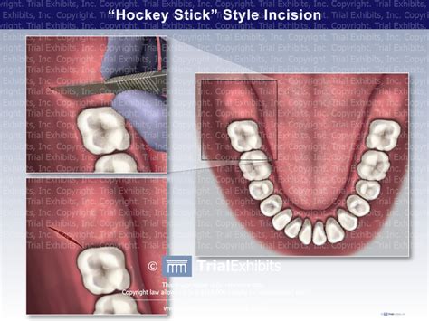 Hockey Stick Style Incision Trial Exhibits Inc