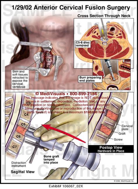 Anterior Cervical Fusion Surgery Medical Illustration Medivisuals