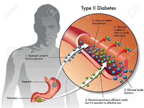 BiologÍa Molecular Alteraciones De La Genómica De La Diabetes Mellitus Tipo Ii
