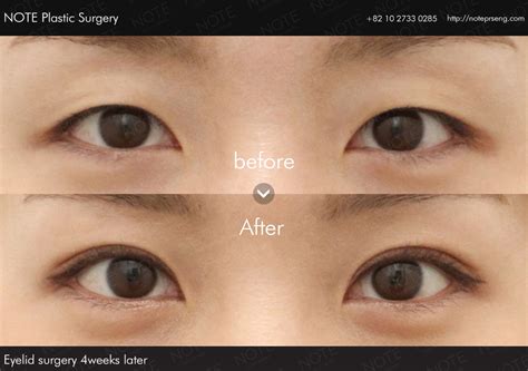 Eyelid Surgery In Korea Before And After Photos Note Plastic