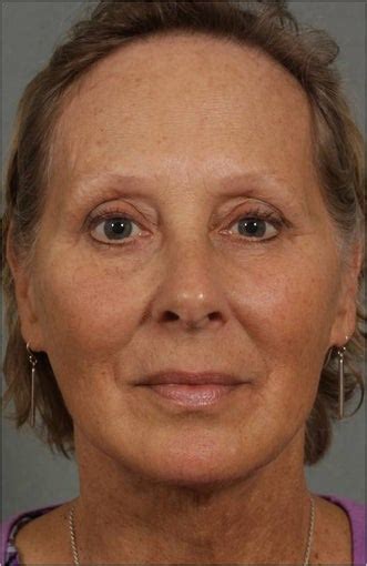62 Year Old Female With Loss Of Facial Volume Contributing To Sagging