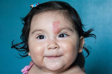 Birthmarks 101 What You Need To Know Us Dermatology Partners