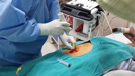 Biopsie Rénale Réalisation 📍 Kidney Biopsy Procedure 🚑 Youtube