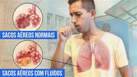 O Que é Pneumonia Causas E Tratamentos Enfermagem Florence