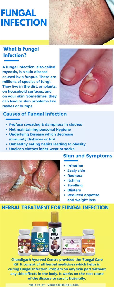 Ppt Fungal Infection Causes Symptoms And Herbal Treatment Powerpoint