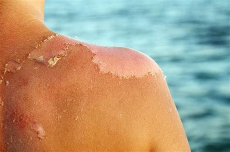 How To Treat A Sunburn What Is A Sunburn Spfsunscreen Info