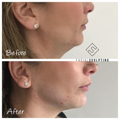 Jawline Fillers Facial Sculpting Jawline Fillers Specialist In London