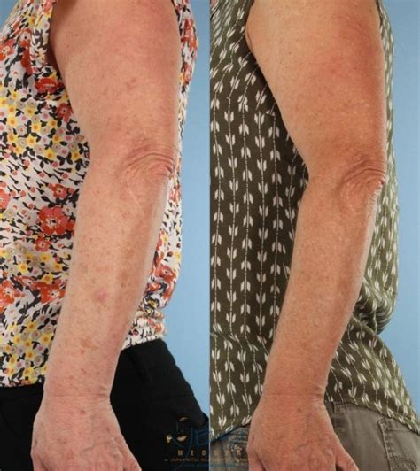 Patient Before And After Photobody Treatment Full Arms