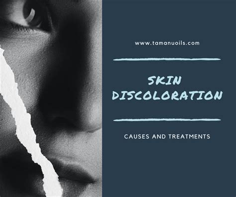 Skin Discoloration Causes And Treatments