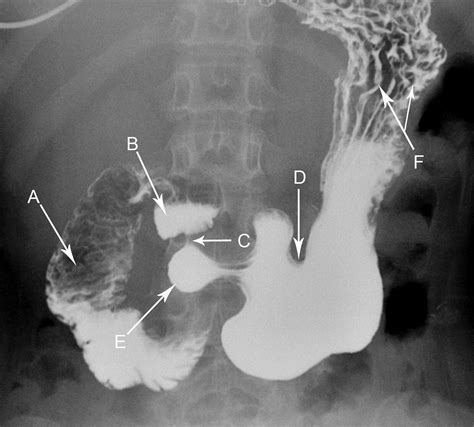 Anteroposterior Radiograph Of A Barium Examination Of The Stomach The Bmj