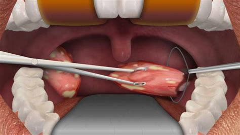 Tonsillectomy Is A Surgical Operation For The Complete Removal Of
