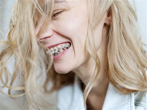 Self Ligating Braces How They Differ Benefits Cost