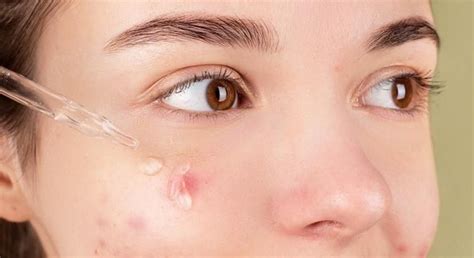 How To Clear Clogged Pores Dermatologist Approved Methods Ph