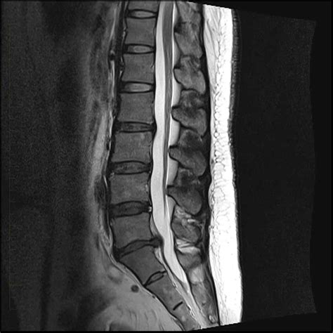 Mri Of The Lower Back Melbourne Radiology