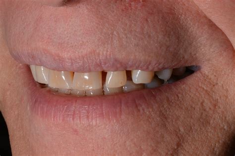 Fixing Gaps Between Front Teeth