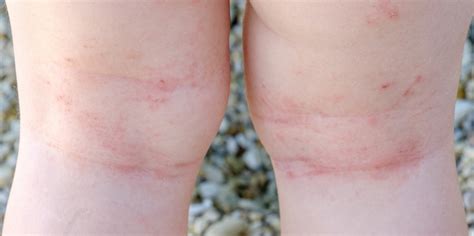 Dermatite Atopica Nel Neonato Sintomi Rimedi E Come Prevenire