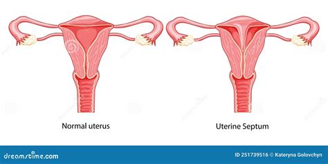 Uterine Septum Septate Uterus Female Reproductive System Diagram With Inscriptions Text Human