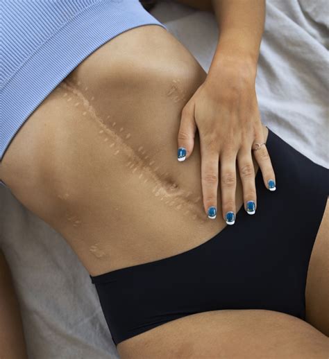 Scars Cellulite Stretch Mark Nuself