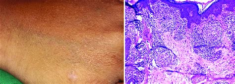 A Hypopigmented Anesthetic Macule Of Borderline Tuberculoid Leprosy