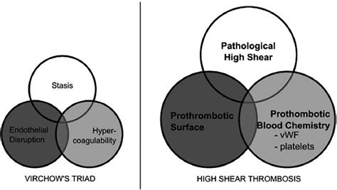 Virchows Triad And Alternative Triad For The High Shear Thrombosis