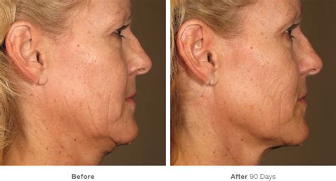 Before And After Gallery Non Surgical Ultrasound Lift Merz Ultherapy