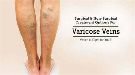 Varicose Vein Surgery Vs Non Surgical Treatments Which Is Right For