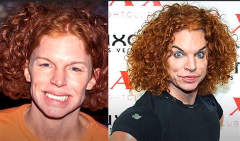 Carrot Top Before And After Plastic Surgery Photos Plastic Surgery Log