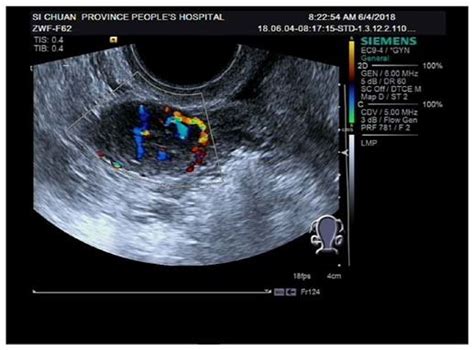 Color Doppler Ultrasound Image Of Patients With Positive Ovarian Sex