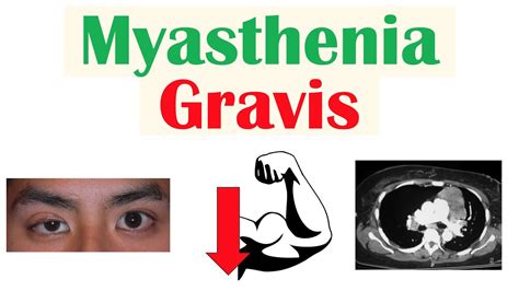 Myasthenia Gravis Pathophysiology Signs And Symptoms Diagnosis Treatment Youtube