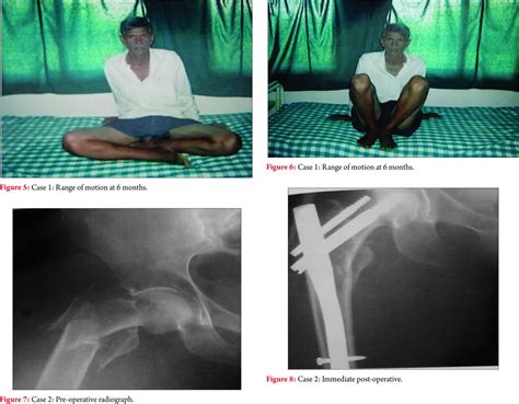 Functional Outcome Of Unstable Intertrochanteric Femur Fracture