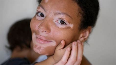 Apprenez à Connaître Le Vitiligo Et Ses Différents Traitements Que Les
