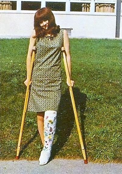 1960s Long Leg Cast Girl 1960s Long Leg Cast Girl With Dec Flickr