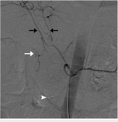 Angiogram Of Celiac Artery Showing Active Extravasation Of Contrast