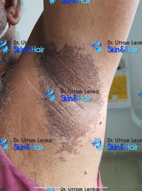 Gallery Advanced Diagnosis And Treatment Dr Uttam Lenkas Skin