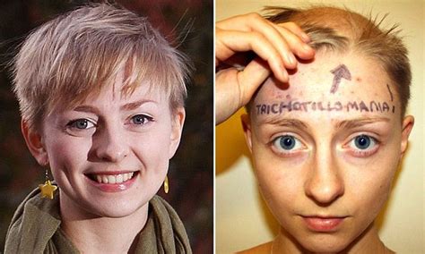 Student With Rare Hair Pulling Condition Trichotillomania Becomes