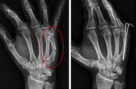 Hand Fractures And Joint Injuries Plastic Surgery Key