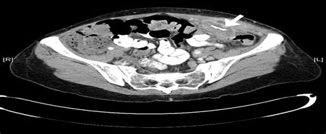 Abdominal Wall Abscess Presenting 35 Years After Insertion O