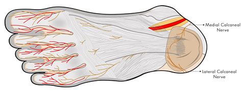 Calcaneal Nerve Causing Heel Pain Dubai Podiatry Centre