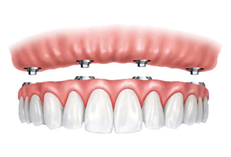 Loose Dentures Crossings Dental