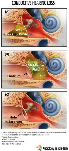 Eardrums Seen In 8 Conditions Normal Eardrum Acute Otitis Media