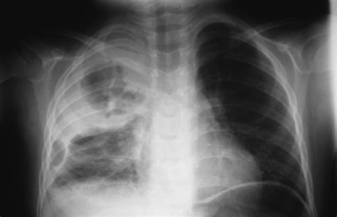 Therefore, the valid conclusion here is that ml is able to have a higher i think it is pretty clear this task is not sensible. Chest x-ray: staphylococcal pneumonia | Wellcome Collection