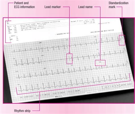 Basic 12 Lead Electrocardiography Anesthesia Key