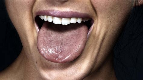 Black Hairy Tongue Syndrome इस इंसान की जीभ पर उगे बाल जानिए कैसे