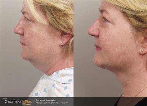 Smartlipo Triplex™ Can Target The Jowls Neck Thighs Stomach Chest