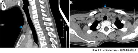 Epidermoid Cyst Of The Suprasternal Region A Rare Case Report