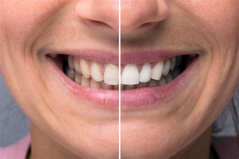 What Is Cosmetic Dental Surgery Bright Smile Dental Powell