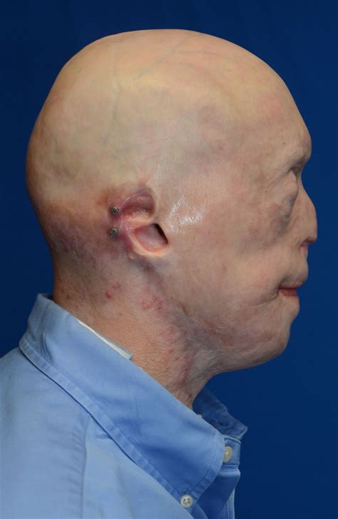Graphic New Photos Of Face Transplant Show Burn Patient S Remarkable Rebirth Huffpost Impact